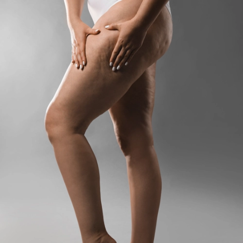 Fotografia de programa lipedema